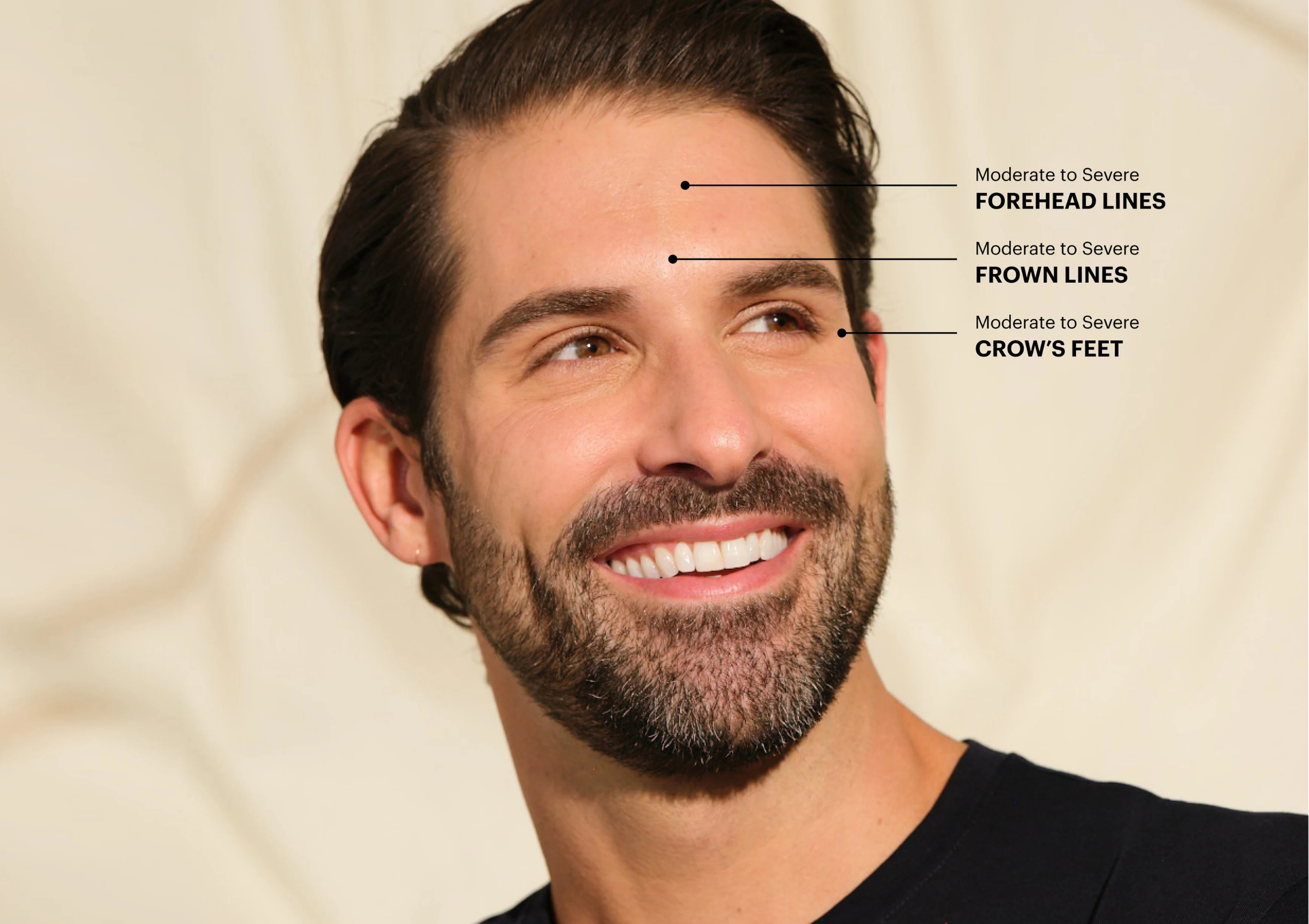Close-up of a smiling man's face with arrows labeling forehead lines, frown lines, and crow's feet wrinkles.